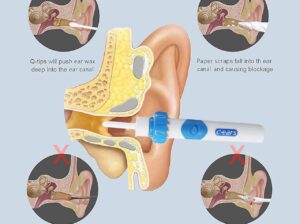 جهاز تنضيف الاذن بواسطة الشفط